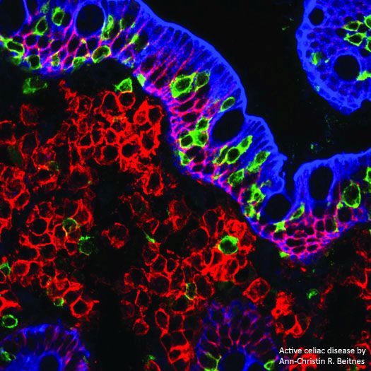 Active celiac disease by Ann-Christin-R. Beitnes